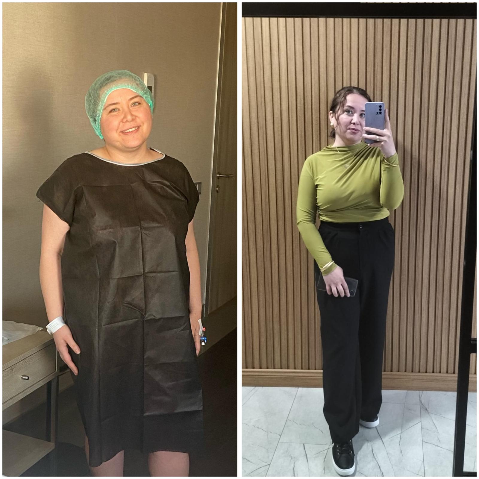 Tüp Mide Ameliyatı öncesi ve sonrası