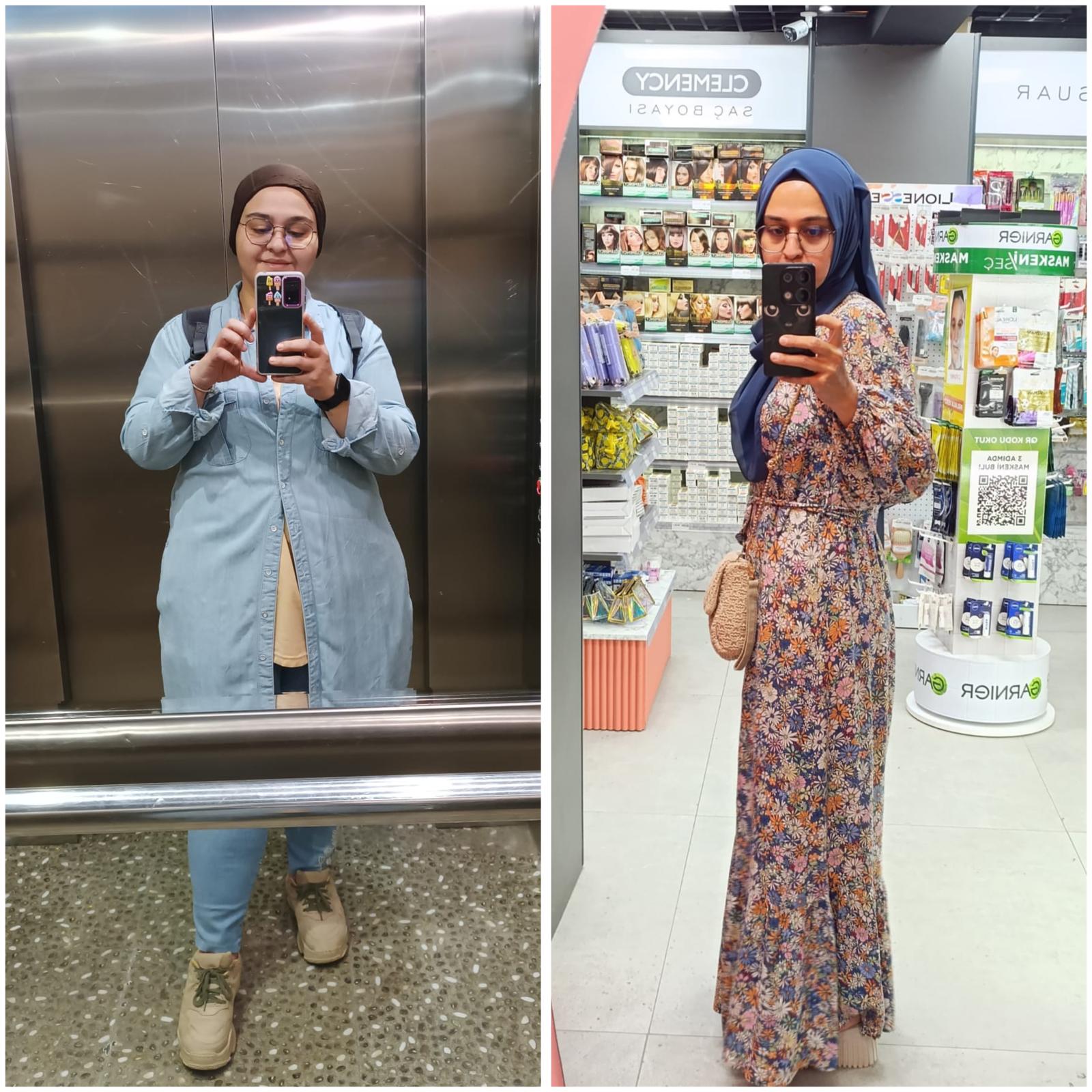 Tüp Mide Ameliyatı öncesi ve sonrası