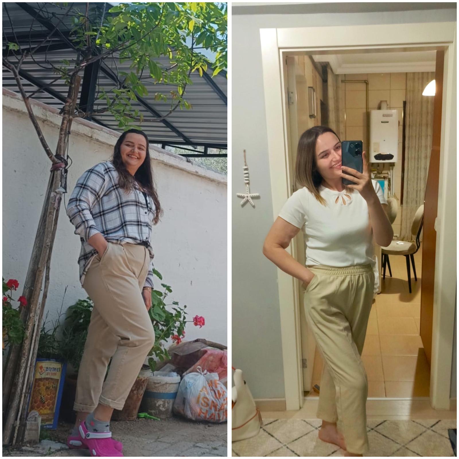 Tüp Mide Ameliyatı öncesi ve sonrası